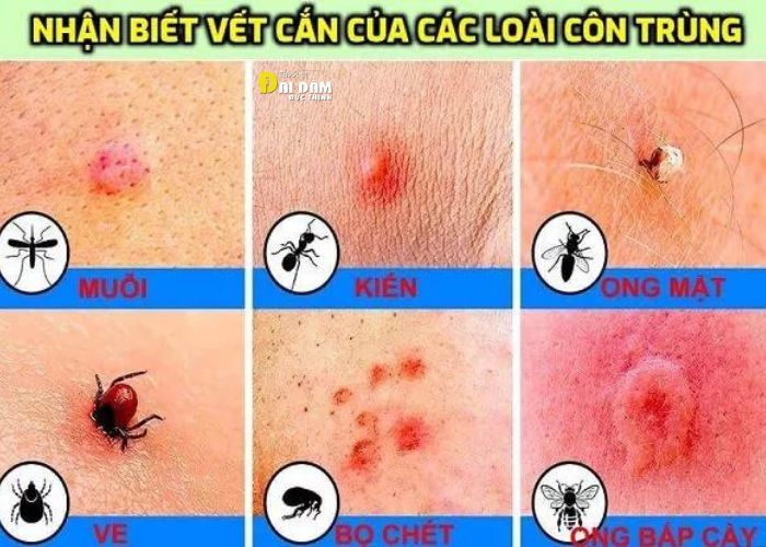 Bị côn trùng cắn cũng có thể gây mẩn ngứa vùng da cổ