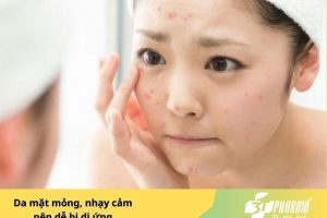 Da mặt mỏng, nhạy cảm nên dễ bị dị ứng