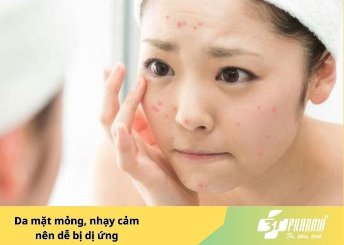 Da mặt mỏng, nhạy cảm nên dễ bị dị ứng
