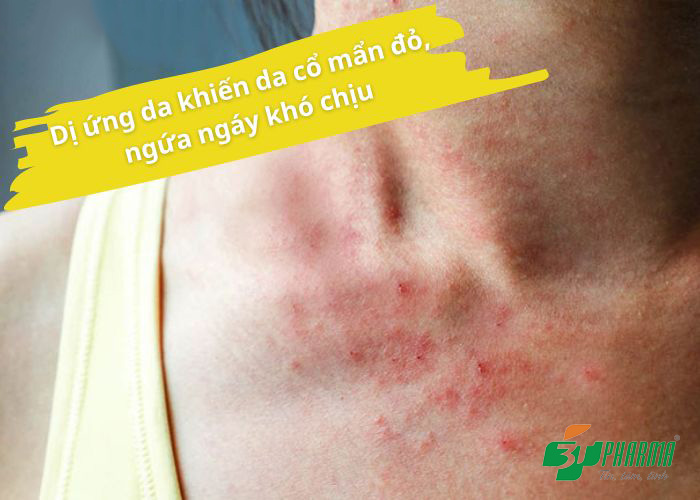 Dị ứng da khiến da cổ mẩn đỏ, ngứa ngáy khó chịu