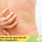 Nguyên nhân nổi mẩn ngứa là gì?