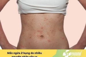 Mẩn ngứa ở bụng do nhiều nguyên nhân gây ra