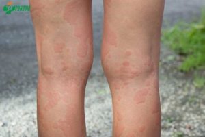 Nổi mẩn ngứa ở bắp chân là tình trạng thường gặp