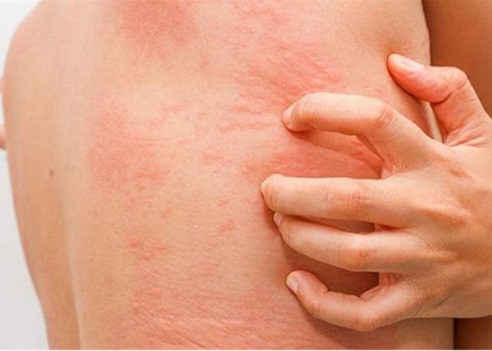 Viêm da dị ứng gây mẩn đỏ, ngứa ngáy trên da