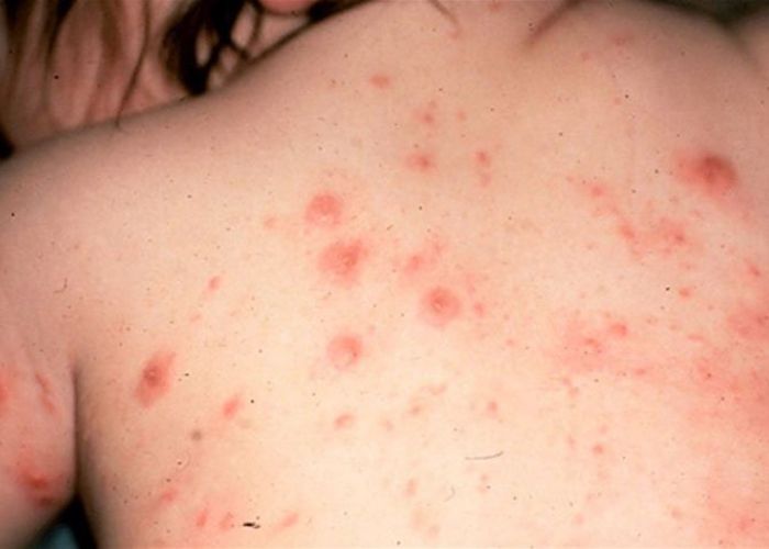 Bệnh ghẻ có thể ảnh hưởng đến vùng da lưng
