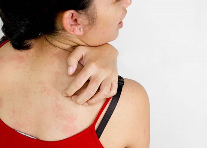 Căng thẳng kéo dài có thể gây ra ngứa ngáy toàn thân