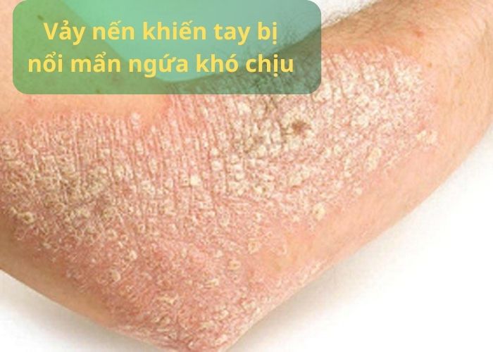 Vảy nến khiến tay bị nổi mẩn ngứa khó chịu