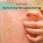 Hay bị dị ứng nổi mẩn ngứa là bệnh gì?