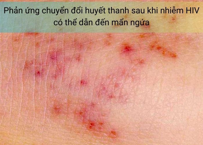 Phản ứng chuyển đổi huyết thanh sau khi nhiễm HIV có thể dẫn đến mẩn ngứa
