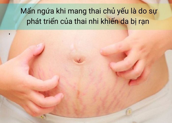 Mẩn ngứa khi mang thai chủ yếu là do sự phát triển của thai nhi khiến da bị rạn 