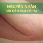 nổi mẩn ngứa ở tay nguyên nhân do đâu