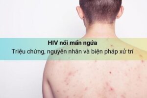 HIV nổi mẩn ngứa: Triệu chứng, nguyên nhân và biện pháp xử trí