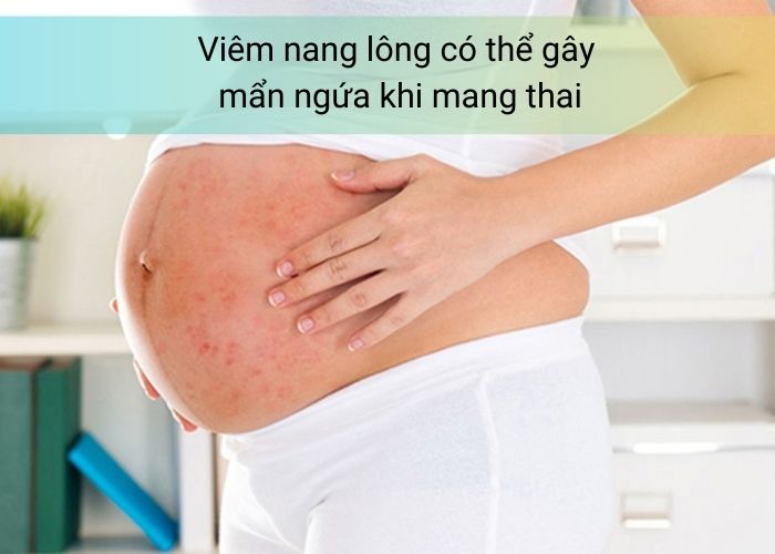 Viêm nang lông có thể gây mẩn ngứa khi mang thai
