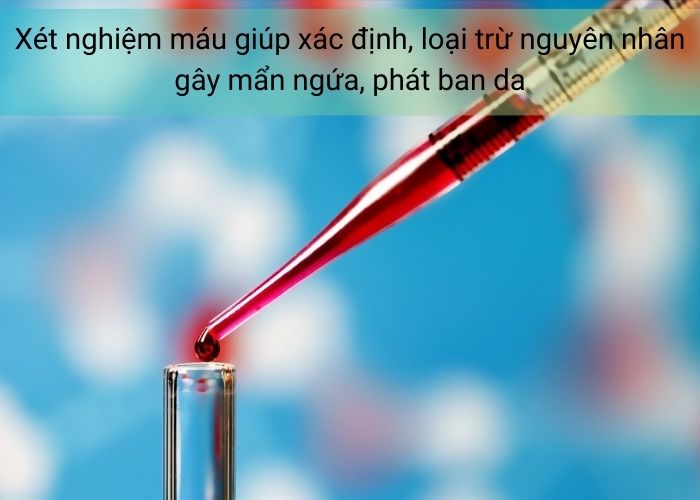 Xét nghiệm máu giúp xác định, loại trừ nguyên nhân gây mẩn ngứa, phát ban da