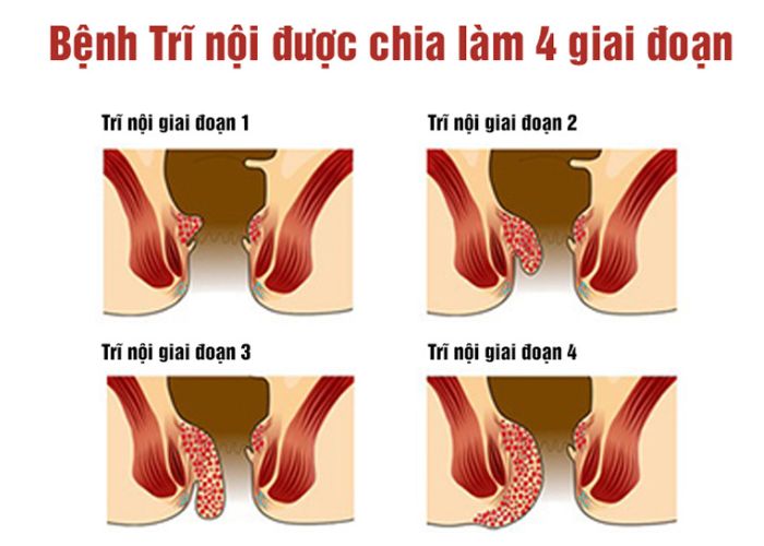 4 cấp độ của bệnh trĩ