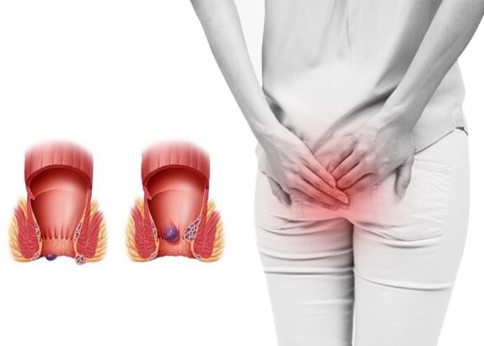 Bệnh trĩ là tình trạng khá phổ biến hiện nay