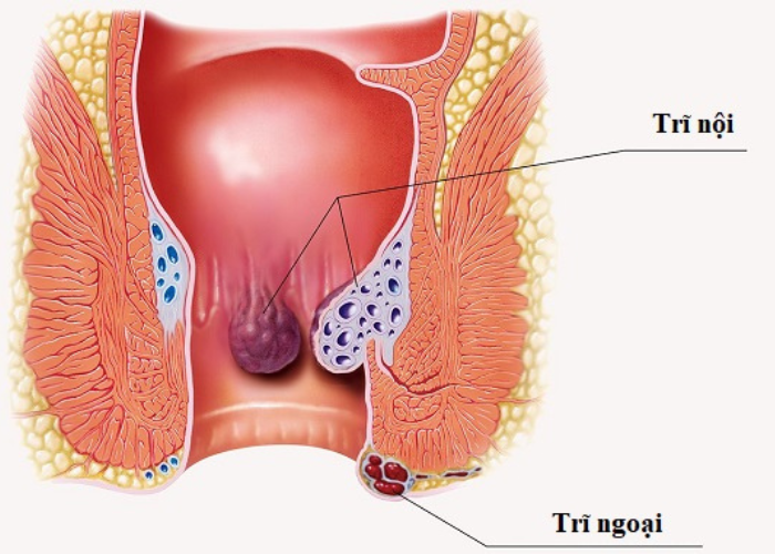 Trĩ nội và trĩ ngoại