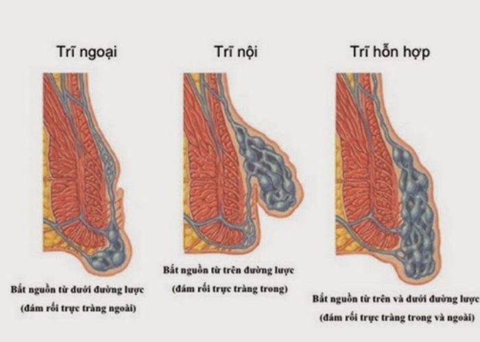 Trĩ hỗn hợp là sự kết hợp của trĩ nội và trĩ ngoại