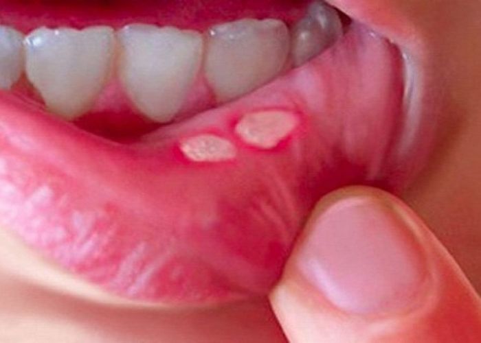 hình ảnh nhiệt miệng, gây đau đớn, khó chịu