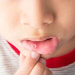 Hình ảnh nhiệt miệng ở trẻ em