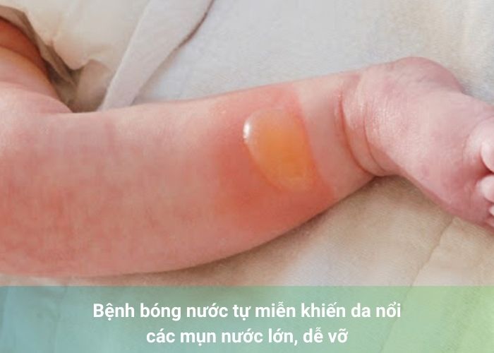 Bệnh bóng nước tự miễn khiến da nổi các mụn nước lớn, dễ vỡ