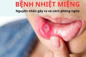 Bệnh nhiệt miêng, nguyên nhân và cách điều trị
