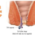 Bệnh trĩ hỗn hợp