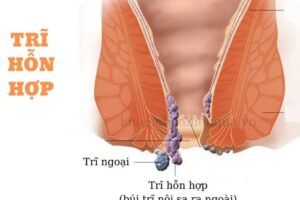 Bệnh trĩ hỗn hợp