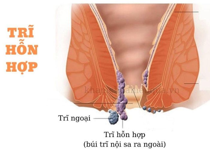 Bệnh trĩ hỗn hợp