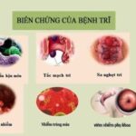 Nhiễm trùng máu là biến chứng nghiêm trọng của bệnh trĩ