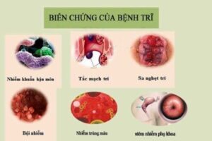 Nhiễm trùng máu là biến chứng nghiêm trọng của bệnh trĩ