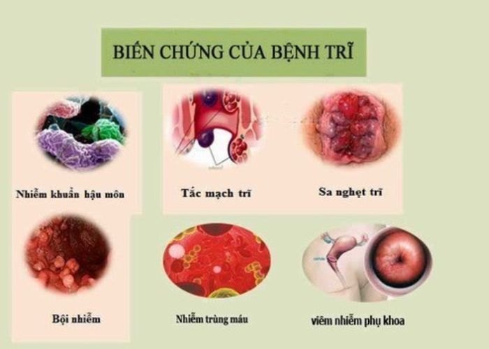 Nhiễm trùng máu là biến chứng nghiêm trọng của bệnh trĩ
