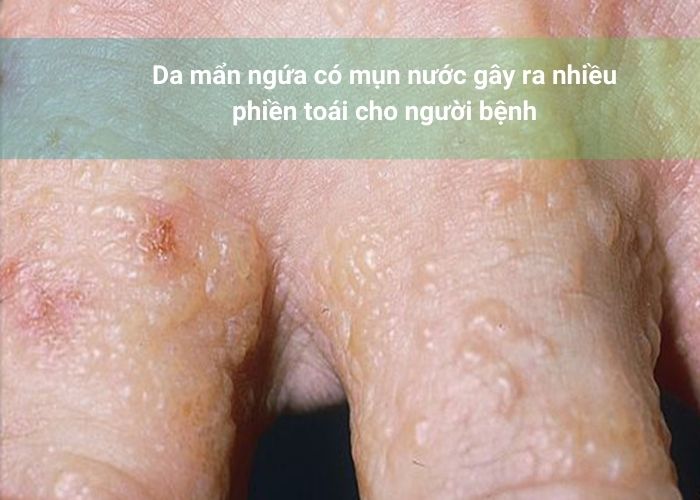 Da mẩn ngứa có mụn nước gây ra nhiều phiền toái cho người bệnh
