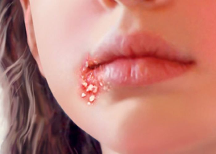 hình ảnh bị lở miệng ở môi