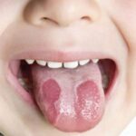 hình ảnh trẻ bị nhiệt lưỡi