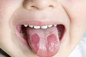 hình ảnh trẻ bị nhiệt lưỡi
