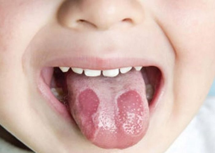hình ảnh trẻ bị nhiệt lưỡi