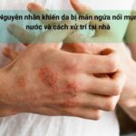 Da mẩn ngứa có mụn nước gây ra nhiều phiền toái cho người bệnh