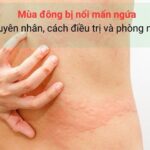 Nguyên nhân mua đông bị nổi mẩn ngứa