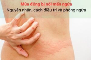 Nguyên nhân mua đông bị nổi mẩn ngứa