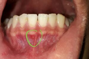 Nhiệt miệng ở chân răng gây khó chịu và đau đớn