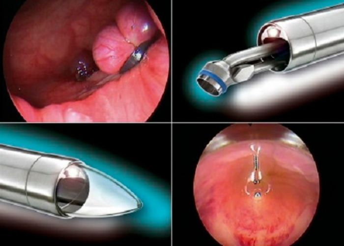 Phương pháp thắt dây cao su điều trị bệnh trĩ