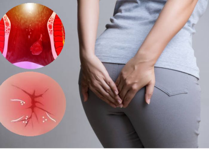 Sa nghẹt hậu môn khiến người bệnh đi ngoài khó khăn, không đại tiện được