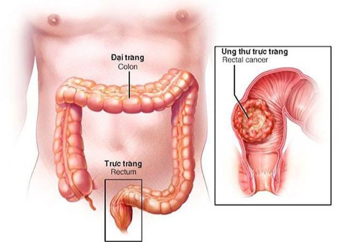 Ung thư đại trực tràng là biến chứng nghiêm trọng khi bị trĩ