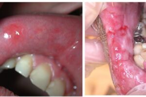 hình ảnh viêm niêm mạc miệng