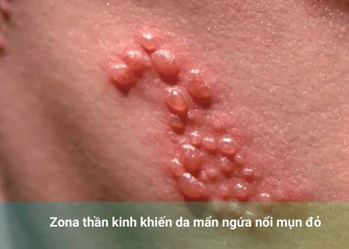 Zona thần kinh khiến da mẩn ngứa nổi mụn đỏ