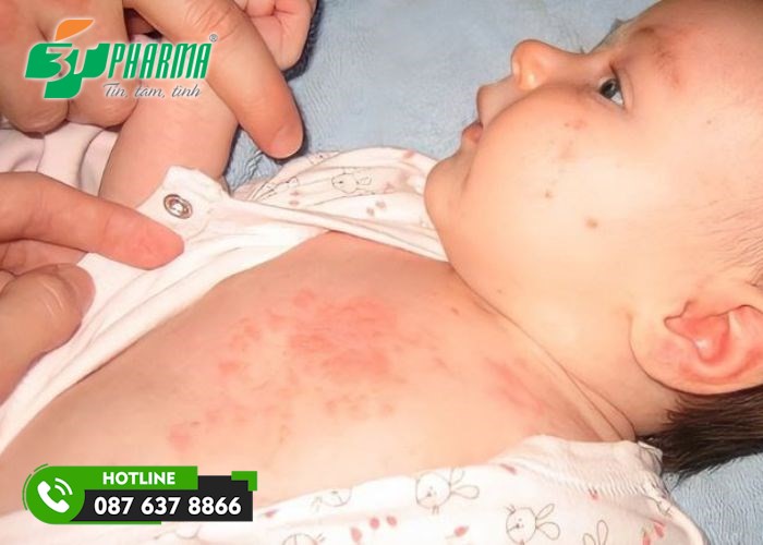 trẻ đổ mồ hôi mà không vệ sinh sạch sẽ cơ thể trẻ có thể khiến trẻ bị rôm sảy - 3T Pharma