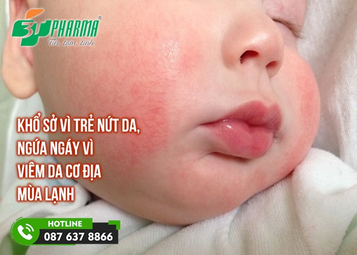 Khổ sở vì trẻ nứt da, ngứa ngáy vì viêm da cơ địa mùa lạnh - tin sức khoẻ - 3T Pharma