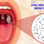 dau hieu nhan biet benh bach hau