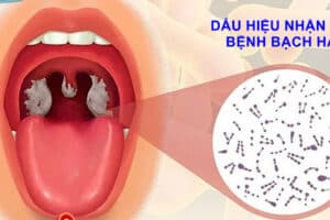 dau hieu nhan biet benh bach hau